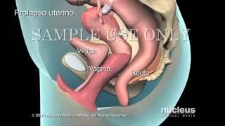 Reparación de prolapso uterino JC