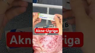 Ugri dog’laga qarshi uy sharoitida davolash #skincare #skincareroutine #uzbekchastrim #beauty