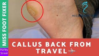 Callus Back From Travel | Miss Foot Fixer | Marion Yau