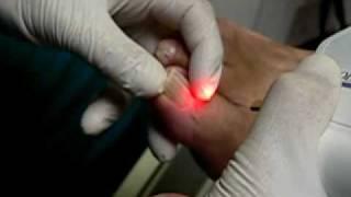 Tampa Laser Toenail Fungus | Dr. Marc Katz | Advanced Podiatry | Fungus Toenail
