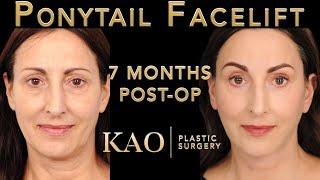 Ponytail Facelift Before And After Video - eyebrow Lift - Plastic Surgery Cost? The Art
