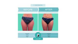 Shape your perfect body with cooltech | cocoon medical