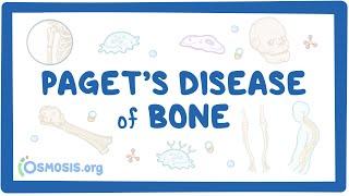 Paget disease of bone