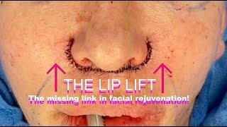 The Lip Lift - The missing link in facial rejuvenation !