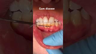 Gum disease , Gum bleeding #viral #shorts#youtubeshorts #dentist #fyp #teeth#video #trending #tiktok