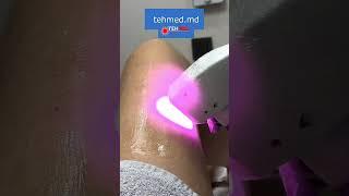 Диодный лазер для удаления волос Aparat Epilare Definitiva Dioda Laser video 5