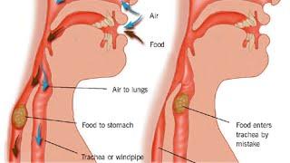 Aspiration Pneumonia