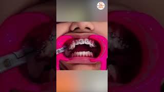 Best Dental Hospital In Hyderabad For Braces | Survival Guide For Braces | Eledent Hospital #shorts