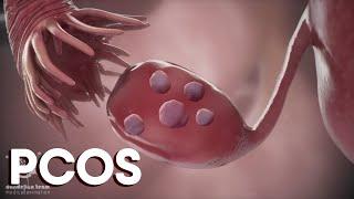 menstruation and  Polycystic Ovary Syndrome or PCOS | Causes |Treatments|Dandelion Medical Animation