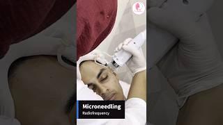 #microneedling #radiofrequency #rejuvenation #skintreatment #facialforglowingskin #cosmetology #skin