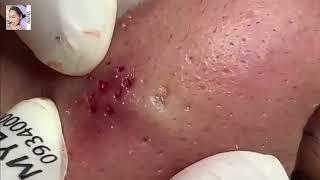 Super Hard Nose Blackheads removal Satisfying !   Anna Facial Treatment   006