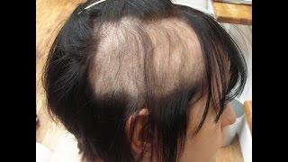 Trichotillomania