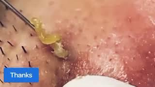 Sac Dep Spa #relax #acne removal satisfying #blackheads treatment new 2025 pimple popping video #012