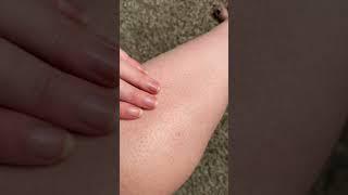 12 weeks of using Lumi IPL Hair Removal