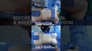 Before & After Transgender 360 Liposuction & BBL with Breast Augmentation!