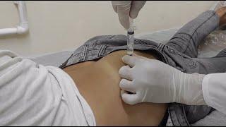 укол в ягодицу в домашних условиях. IM Intramuscular Injection Ventrogluteal Buttock Muscle