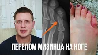 Перелом мизинца на ноге. Как лечить?