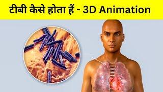 ट्यूबरकुलोसिस (TB) कैसे होता हैं ? tuberculosis etiology  & pathophysiology