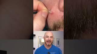 Doctor reacts to slimy pimple patch removal! #dermreacts #doctorreacts #pimplepop