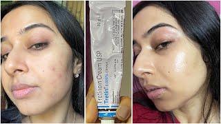 Unsponsored Simple Tretinoin Night Skincare Routine for Acne free Skin #skincare #tretinoin