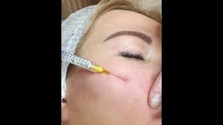 Контурная пластика, работа с канюлей  |Beauty Clinic Roksolana