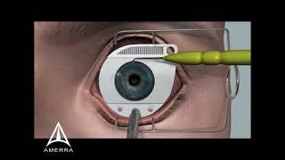 LASIK Eye Surgery Lore