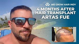 4 Months after ARTAS Robotic FUE Hair Transplant - We Grow Hair Indy