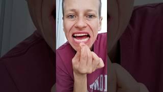 перестала чистить зубы. результаты #зубы #зубыдоипосле #здоровьезубов #безхимии #народнаямедицина