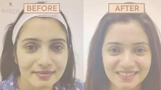 Radiance Peel Treatment for Instant Glow in Skin || Before & After Results