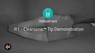 Helse Ultrasonic Endo - Retreatment - R1 Clearsonic™ Demonstration