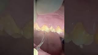 Teeth Scaling tartar & calculus #dentist