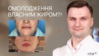 ЛІПОФІЛІНГ ОБЛИЧЧЯ: молодження власним жиром Grace Clinic