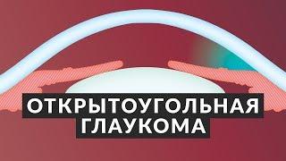 ️ Открытоугольная глаукома ️ 5 фактов об открытоугольной глаукоме! Доктор Лапочкин