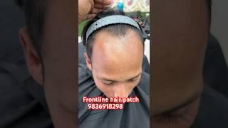 Men’s hair patch. Hair patch in Kolkata.best hair patch centre in Kolkata.hair wig. Human hair wigs