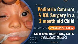 Pediatric Cataract & IOL Surgery in a 3 month old Child SuVi Eye Kota India.mpg