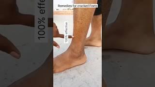 Remedies For Crecke Feet #shorts #youtubeshorts #feetcare #viral#Creckefeet