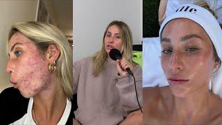 Alix vs. Acne | Hot Mess with Alix Earle