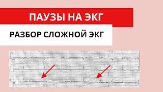 Паузы на ЭКГ. Разбор сложной ЭКГ. Блокированные экстрасистолы.