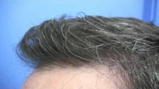 Hair Transplant by Dr Jerry Wong - 2932 Grafts - 2 Sessions