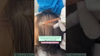 {2024 } PRP - Best hair loss treatment for females #shorts