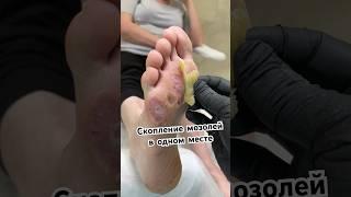 Россыпи стержневых мозолей в одном месте | стала чувствовать свои ноги #мозоли #подологмосква