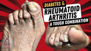 Diabetes & Rheumatoid Arthritis, A Tough Combination