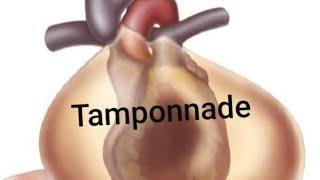 Tamponnade : hémopéricarde