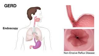 ECE-2b-Pathology of Esophagus-GERD-Erosive esophagitis