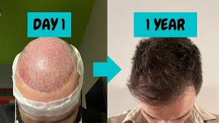 FUE Hair Transplant 1 year update | SMILE Hair Clinic Istanbul