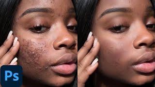 Skin retouching for beginners only (photoshop tutorial )