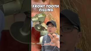 Things to Consider When Getting a Front Tooth Filling | View Mobile Dental