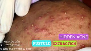 Mụn ẩn siêu nhiều mụn mủ viêm|Big acnes pimples,pusstule,blackheads extraction Dr Hoan 0985773391