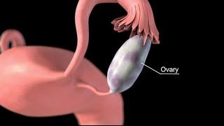 Ovarian Cancer