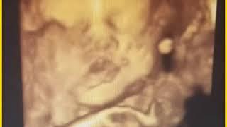 28 week 3d Ultrasound